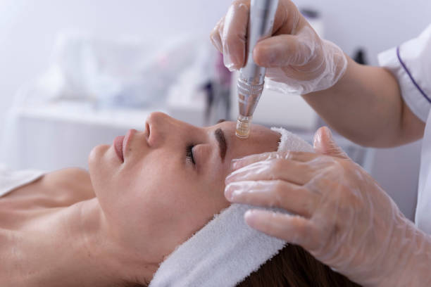 Microneedling προσώπου – θεραπείες δέρματος AJ BEAUTY ROOM στη Γκύζη, Αθήνα | Microneedling facial treatment – AJ BEAUTY ROOM Gizi Athens